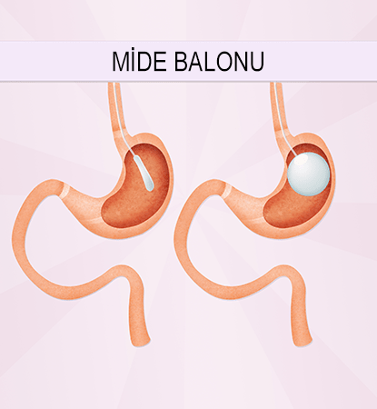 Mide balonu ameliyatı işlemi nasıl yapılıyor?